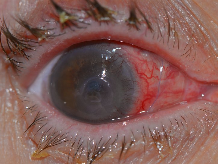Симптомы, лечение и последствия акантамебного кератита глаз 